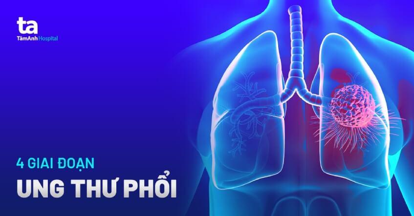 ĐIỀU TRỊ ĐÍCH TRONG UNG THƯ PHỔI GIAI ĐOẠN TIẾN XA