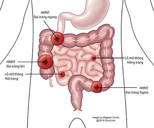 Chăm sóc hậu môn nhân tạo