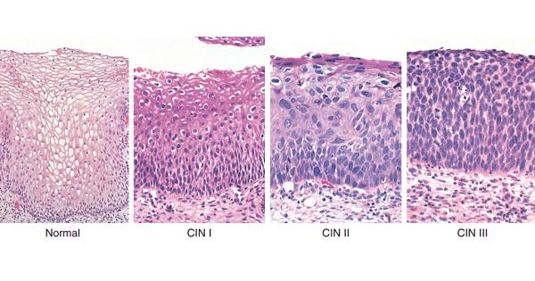 Cin 1,2,3 cổ tử cung là gì?