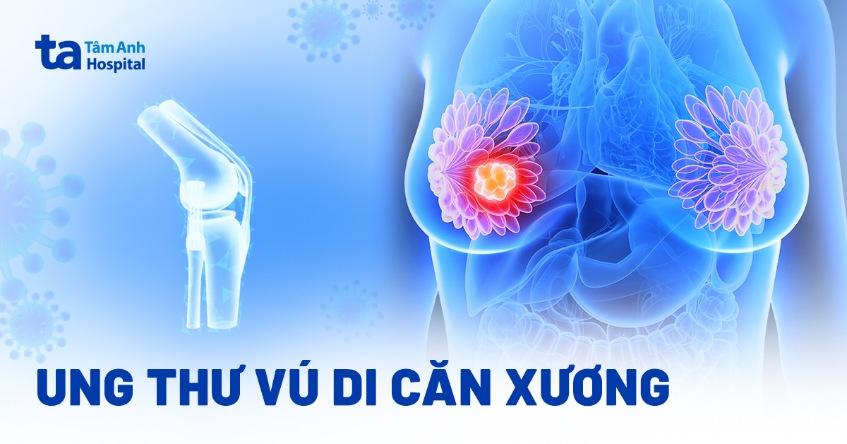 Ung thư di căn xương là gì? Triệu chứng ung thư di căn xương