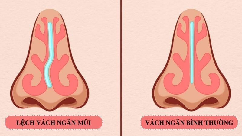 Phẫu thuật vách ngăn mũi giá bao nhiêu? Thời gian hồi phục sau phẫu thuật