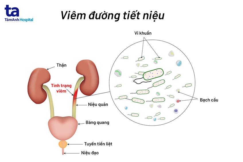 Đơn thuốc kháng sinh điều trị viêm đường tiết niệu