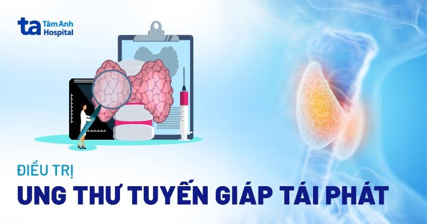 điều trị ung thư tuyến giáp tái phát