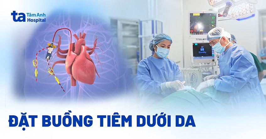 Đặt buồng tiêm dưới da