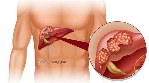 Hình ảnh siêu âm ung thư gan