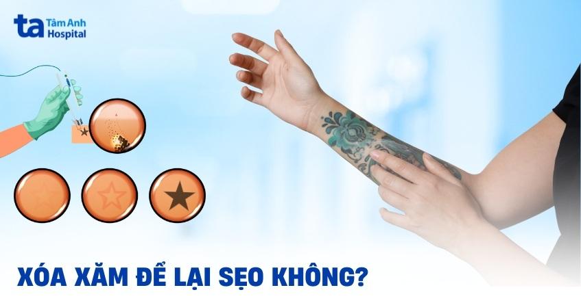 xoá xăm có để lại sẹo không