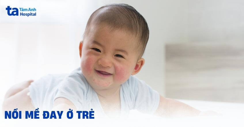 nổi mề đay ở trẻ em