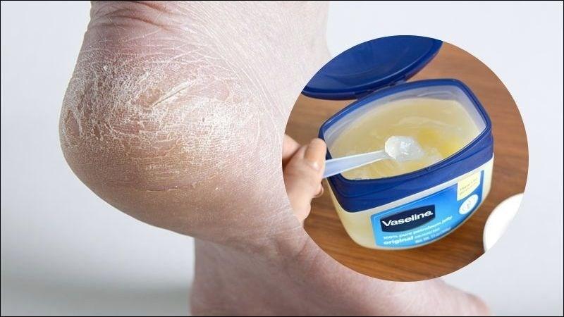 Vaseline giúp phục hồi độ ẩm cho gót chân khô và nứt nẻ.